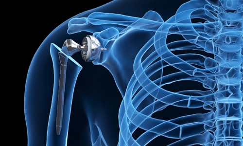Shoulder Prosthesis